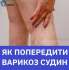 ЯК ПОПЕРЕДИТИ ВАРИКОЗ СУДИН: 6 ПРАВИЛ